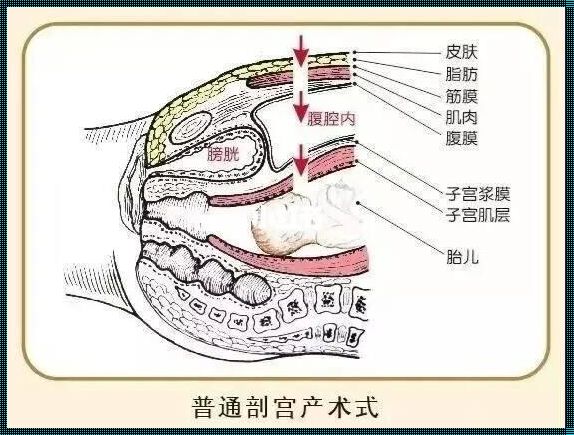 剖腹产后子宫前后径多少正常《子宫前位大小约多少mm是正常的》