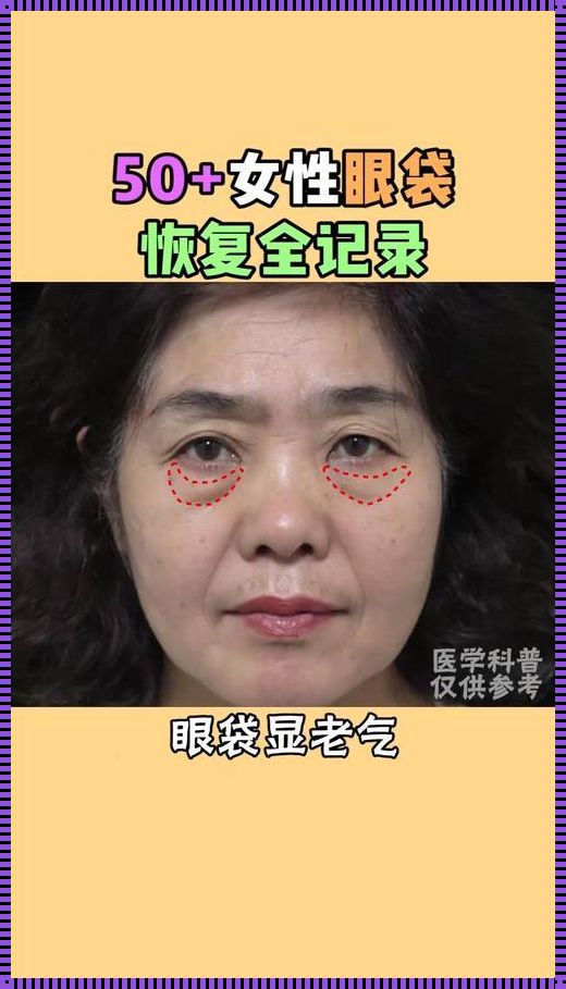 祛眼袋怎么做：打造明亮双眸的秘诀