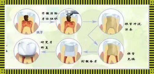 儿童杀神经补牙全攻略：守护宝宝的微笑