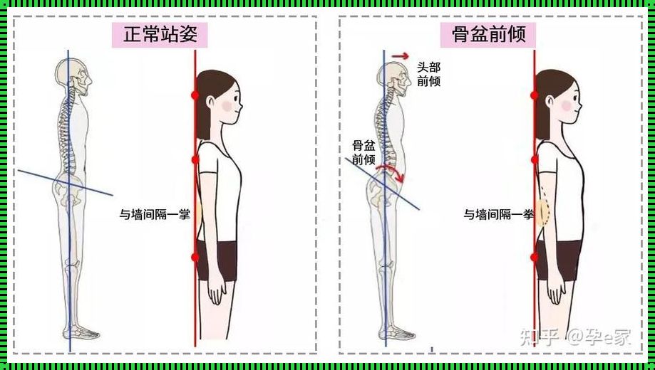 不自觉挺腰：健康新危机