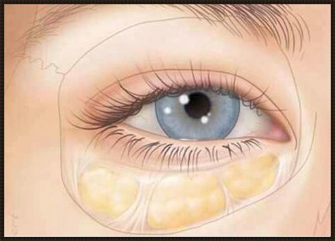 告别眼袋，重拾青春光彩——眼袋治疗全方位指南