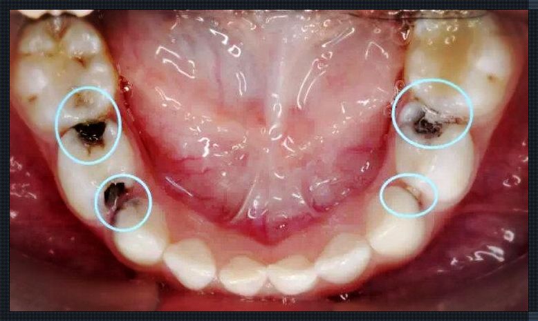 儿童邻面龋应对之道：育儿路上的惊鸿一瞥