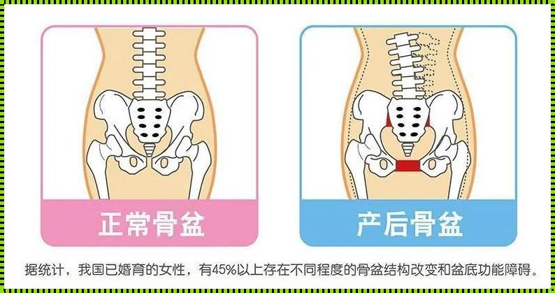 产后骨盆修复风波：一位妈妈的懊悔经历