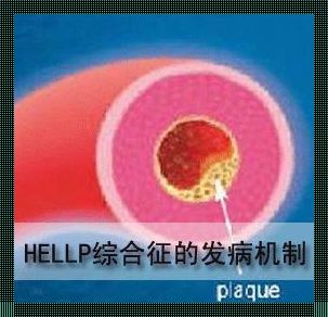 产后HELLP综合征：警惕危险期，科学规划产后护理