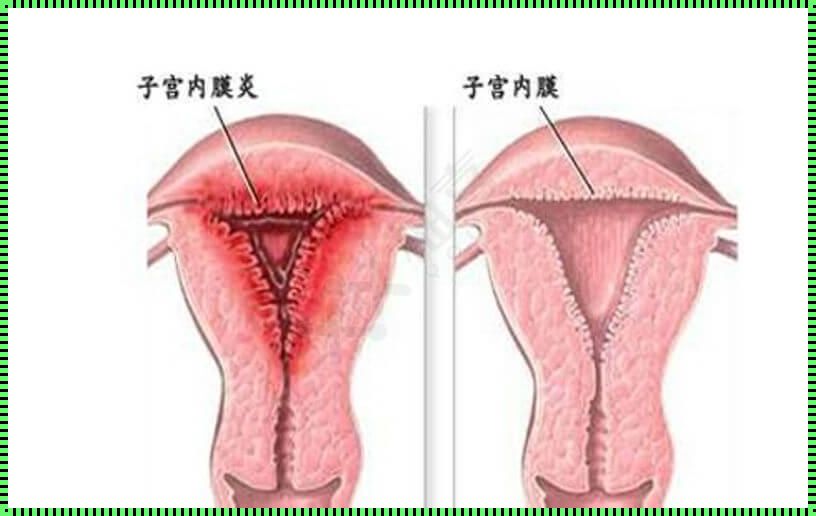 慢性子宫内膜炎治疗时长探讨