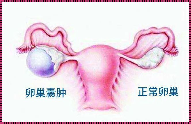 右侧卵巢囊肿：探秘病因与备孕之道