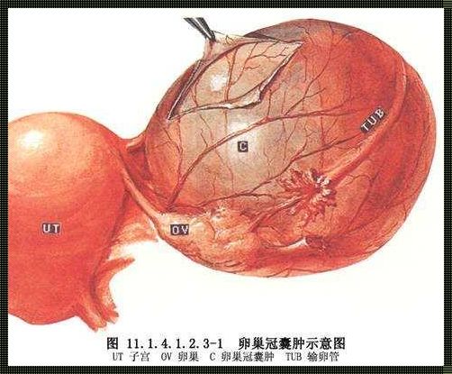 右侧卵巢系膜囊肿：备孕路上的小插曲