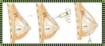 健康知识科普：乙肝注射药物与胸部变大的误解