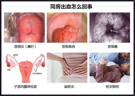 宫颈糜烂出血一般几天：风云再起