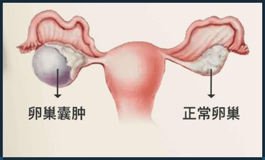 解析盆腔囊肿与卵巢囊肿的差异：备孕路上的明灯