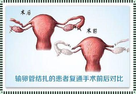 微创输卵管复通术——备孕路上的惊喜发现