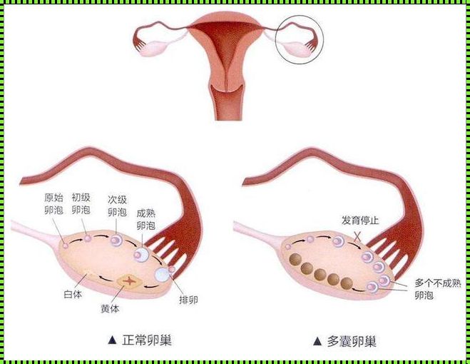 多囊卵巢别再促排了：备孕之路的反思与感悟