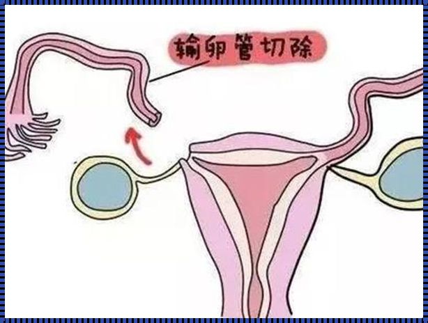 女性输卵管切除后能否再接上的科学解答及备孕建议