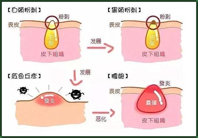 粉刺长时间不挤的后果与美容再造策略