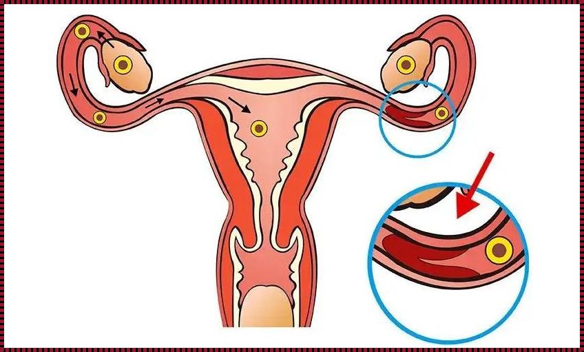 探索生命之桥——输卵管堵塞的自我检查与发现