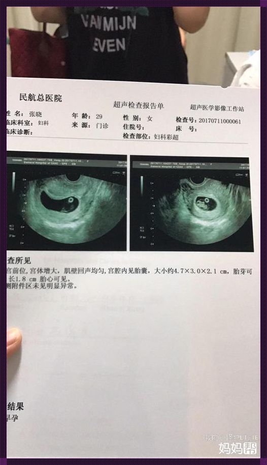 妊囊大小是否能判断胎儿性别？ 科学与迷信的博弈