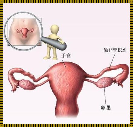 输卵管积水能怀上孩子吗？当阴影褪去，绽放生命之花——患有输卵管积水，惊现孕育奇迹