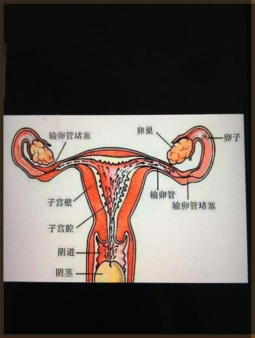 输卵管堵塞可以自愈吗？