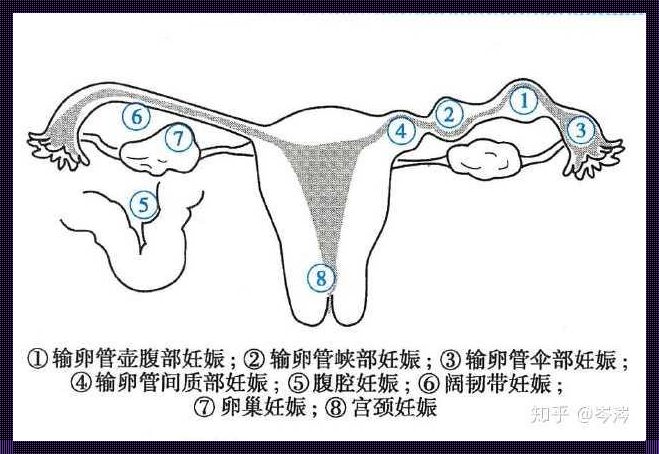 揭开宫外孕在卵巢上的概率：罕见案例敲响生育警钟