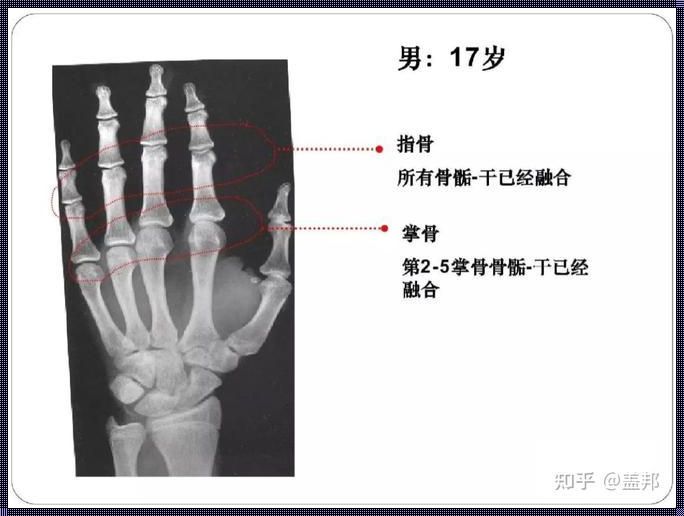 骨龄相当于16岁左右说明什么