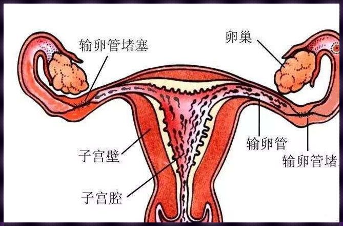 女生为什么会输卵管堵塞：深入剖析女性生育的隐形杀手