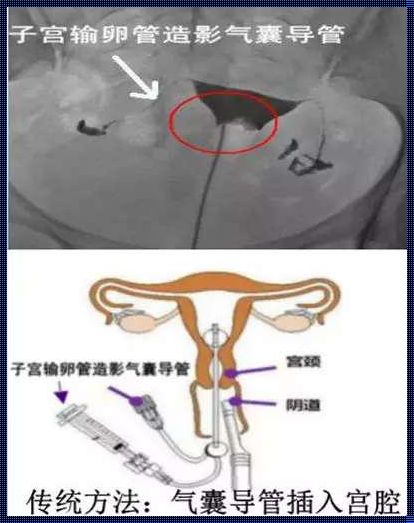 《输卵管造影检查：揭示孕育之路的神秘面纱》