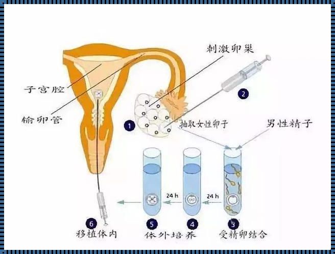 试管婴儿怎么取卵：揭秘加速备孕的奥秘