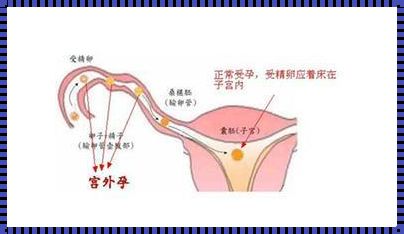 输卵管破裂三大症状——揭秘女性生育的隐形杀手