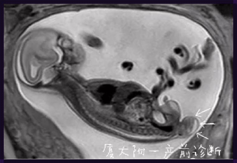 怀孕三个月胎儿彩超：初次见面，欣喜与紧张并存