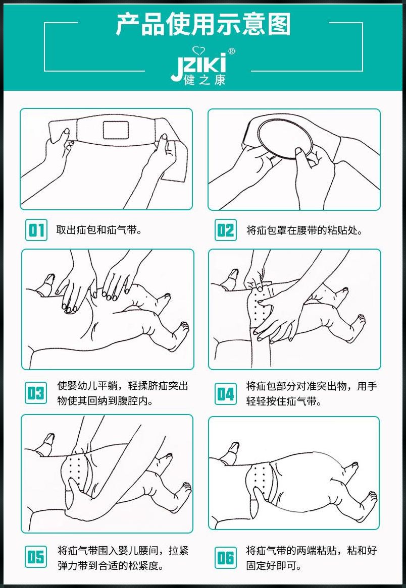 新生儿斜疝怎么处理：全方位的实施策略