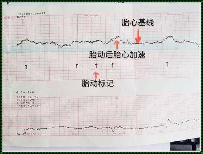 揭秘胎心监护参数正常范围：守护新生命的脉动