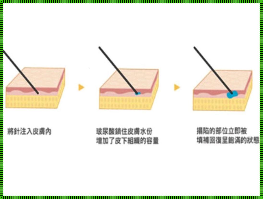 玻尿酸注射方法教程：让你掌握美容惊现的秘诀