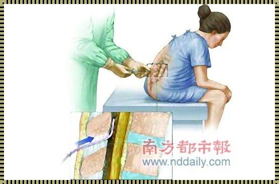 顺产后无痛针的后遗症探究