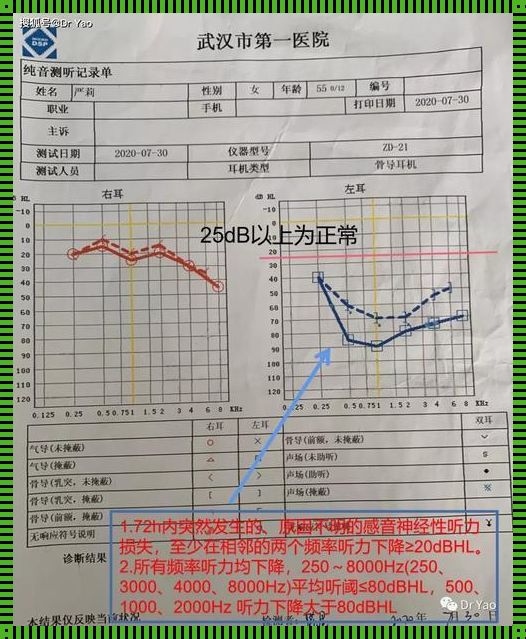 剖腹产后突发性耳聋的揭秘：一场悄无声息的挑战