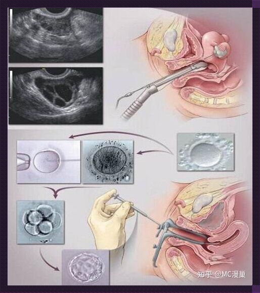 大医院取卵不打麻醉之谜：惊现人性化医疗考量