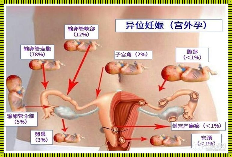 如何判断是不是宫外怀孕