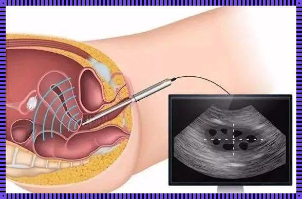 阴式彩超检查前需要注意什么——以情感为核心，注重细节与清洁