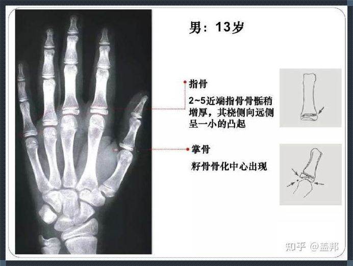 15岁骨龄后只有三厘米空间吗