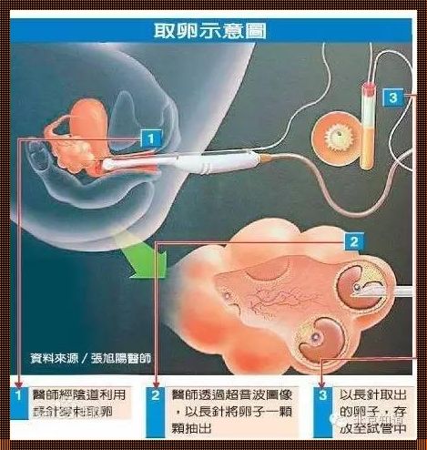 取卵对女人的伤害大吗？