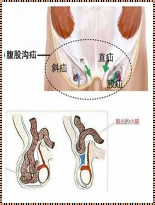 左侧斜疝怎么治疗方法