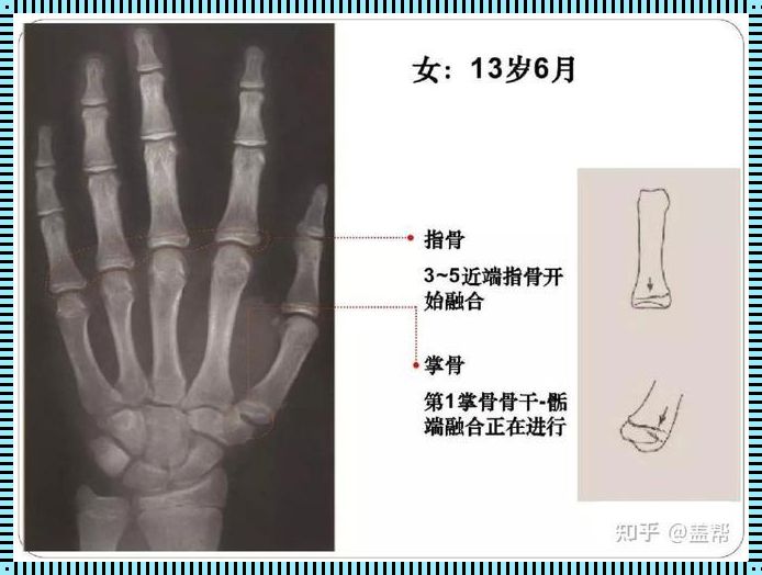 13岁测骨龄多少钱：揭秘骨龄检测的神秘面纱