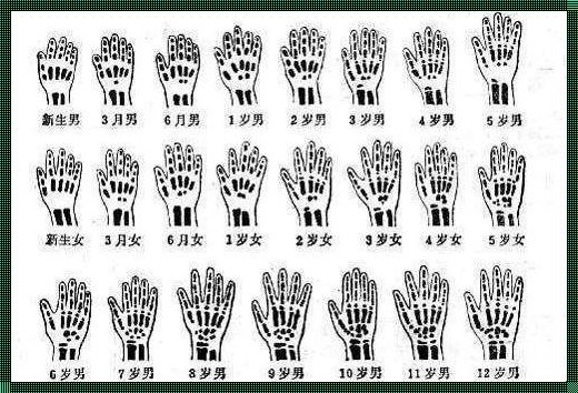 骨龄测量方法有哪几种