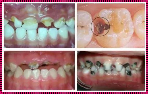怀孕期间蛀牙疼的厉害怎么办？