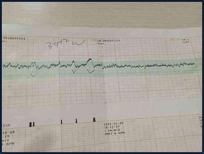 32周胎心监护：守护新生命的重要举措