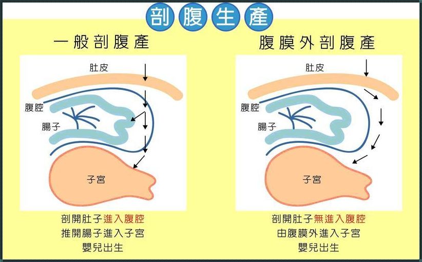 剖腹产产后修复必做三大项目