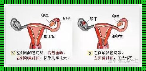 单侧输卵管受孕技巧：寻求希望与可能