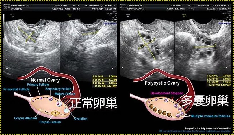 多囊怎么看有无排卵：寻找排卵的蛛丝马迹