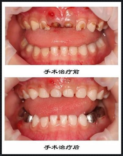 三岁宝宝牙齿腐蚀补救全攻略