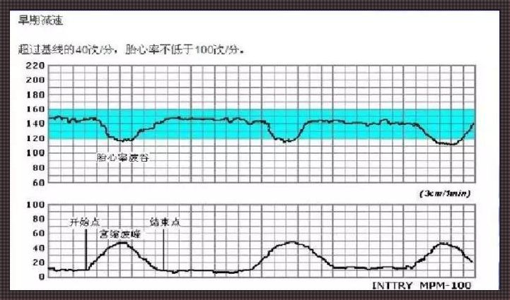 严重缺氧胎心监护图：缺氧的隐忧