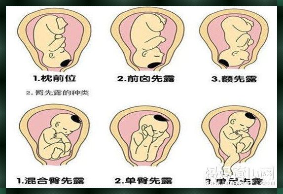 孕31周臀位用不用管他：深入了解与探讨